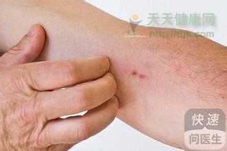 海鲜过敏 海鲜过敏症状要多久    体质不同以及处理方式会导致时间波动